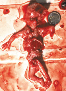 abortion 06